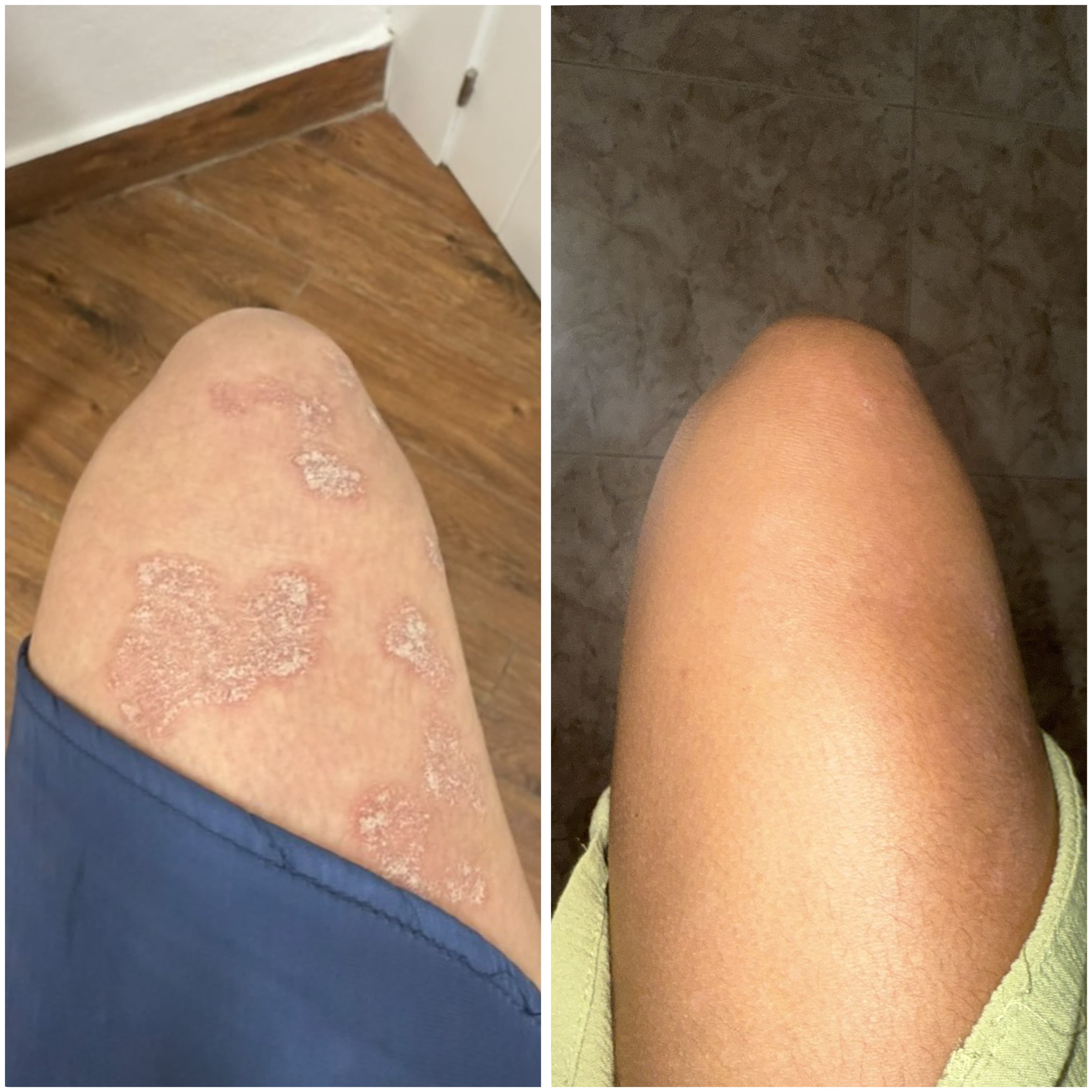 Crème réparatrice au CBD pour peaux sèches, squameuses et à tendance psoriasique.