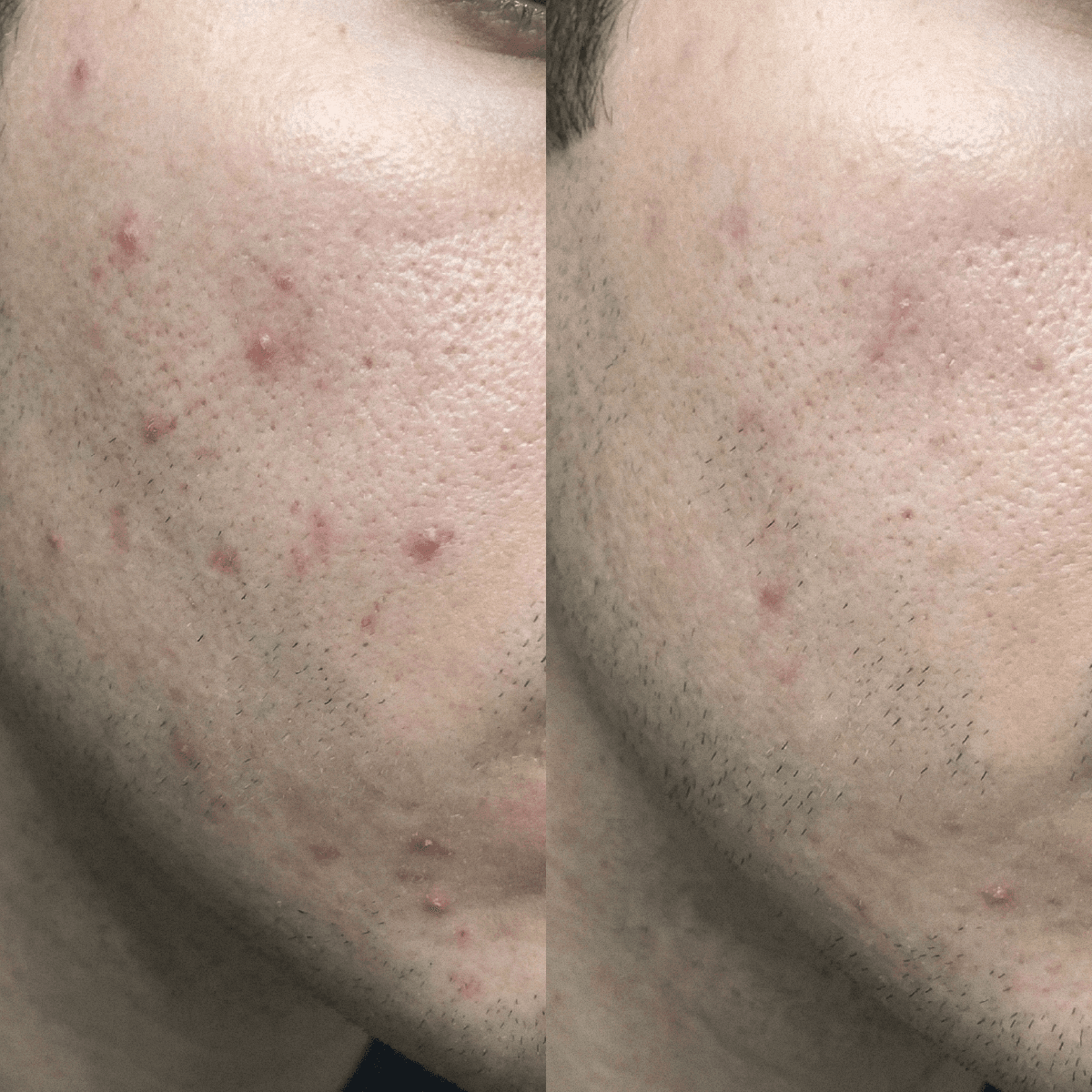 Crème CBD purifiante anti-imperfections pour peaux à tendance acnéique