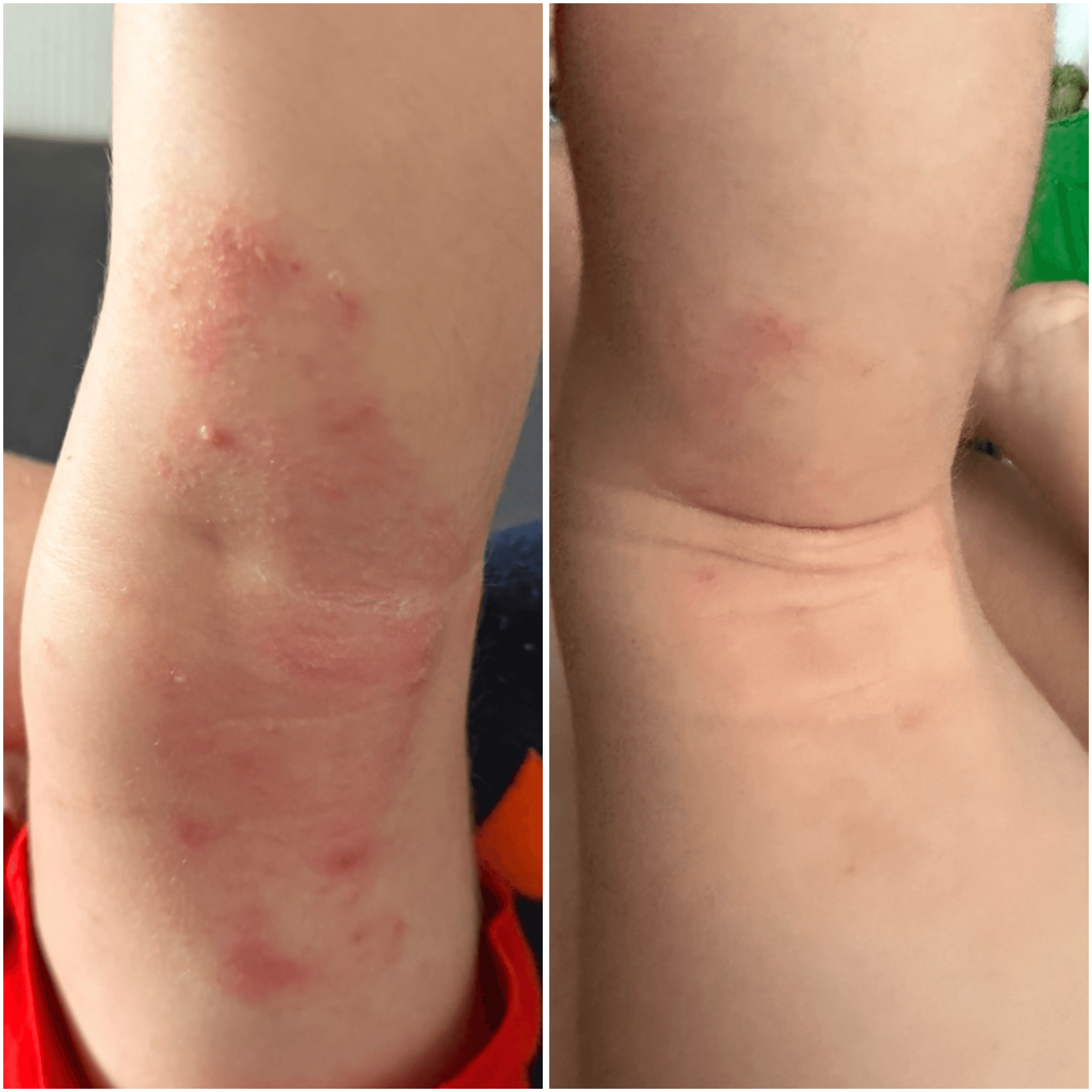 Crème au CBD pour peaux sèches, atopiques et sujettes à l'eczéma