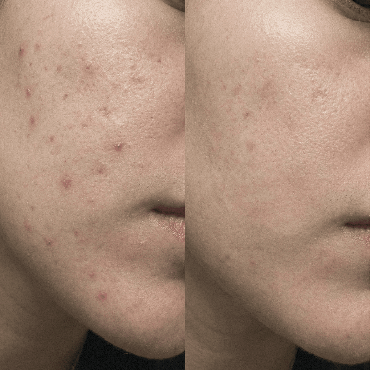 Crème CBD purifiante anti-imperfections pour peaux à tendance acnéique