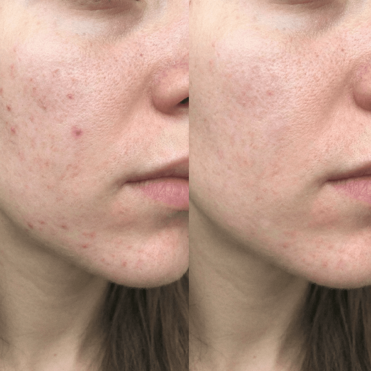 Crème CBD purifiante anti-imperfections pour peaux à tendance acnéique