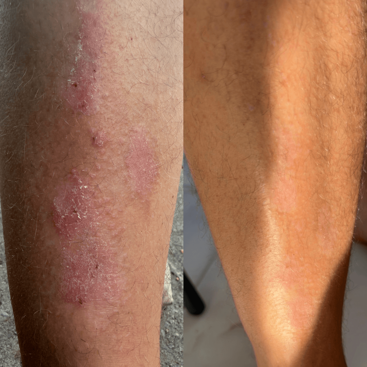 Crème réparatrice au CBD pour peaux sèches, squameuses et à tendance psoriasique.